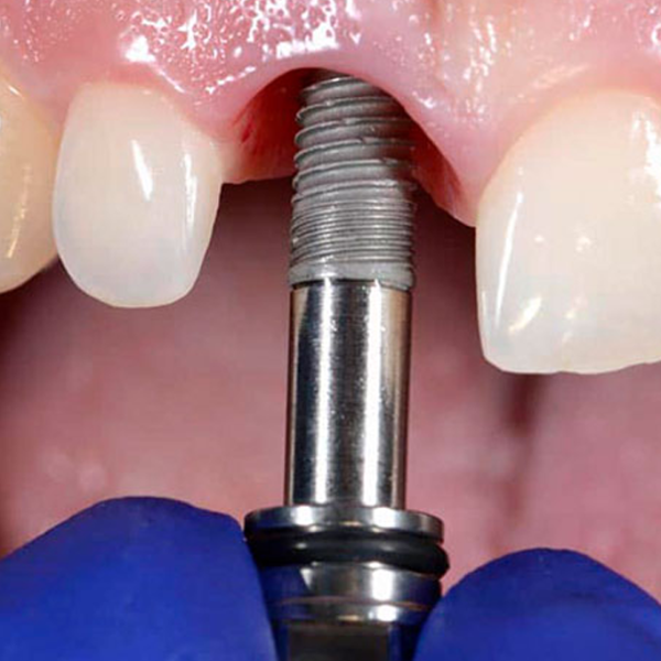 Implantes dentales