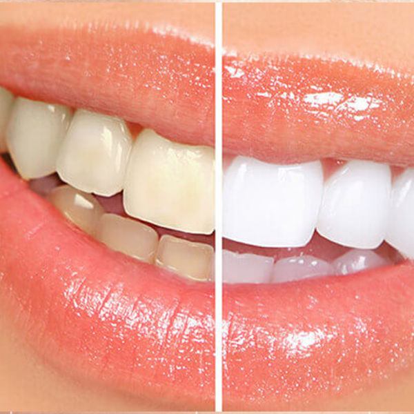 Blanqueamiento Dental
